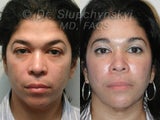 Endoscopic Brow Lift, Lower Blepharoplasty & Blue Peel