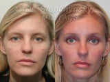 Endoscopic Brow Lift