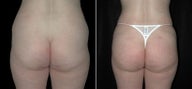 Buttock Augmentation 