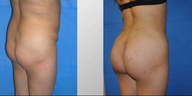 Fat transfer buttock augmentation