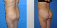 Butt Augmentation