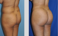 Buttock Augmentation