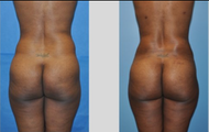  Buttock Augmentation