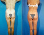 Buttocks Enhancement