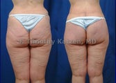 Before and after photo silicone buttock implant and lift after RNY gastric bypass after massive weight loss after 360 bodylift