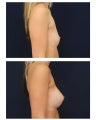 Breast Augmentation