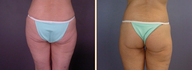 Posterior Lift