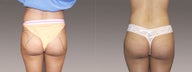 Fat Transfer/Buttock Reshaping 