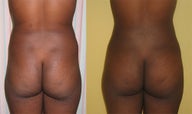 Buttock Augmentation 