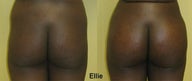 Buttock Augmentation