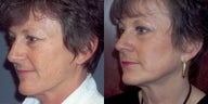 CO2 laser skin resurfacing