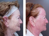 CO2 Fractional Laser