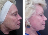 CO2 Fractional Laser