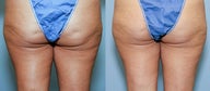 42  year old female with cellulite
