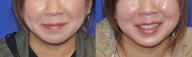 Dimple Creation Surgery