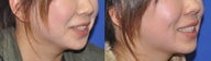 Dimple Creation Surgery