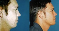 Chin Augementation