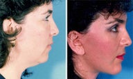 Cheek Lift and Augmentation