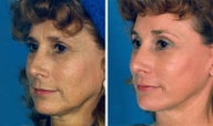 Cheek Lift and Augmentation