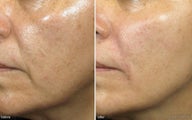 Cheek Augmentation / Cheek Lift