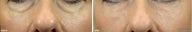 Cheek Augmentation / Cheek Lift