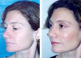 Cheeklift