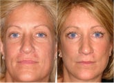 MidFacelift