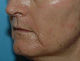 Chemical Peel Recovery
