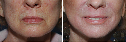 Chemical Peel