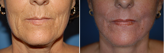 Chemical Peel
