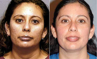Chemical Peel