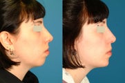 Chin Implant