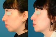 Chin Implant