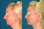 Combination: Rhinoplasty, Chin Implant, & Neck Liposution