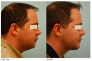 Chin Implant (Alloplastic Chin Augmentation)