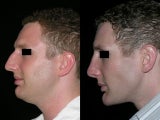Rhinoplasty and chin augmentation
