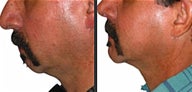 Chin Implant
