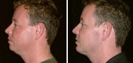 34 year old male, chin implant