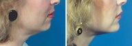 Chin Implant