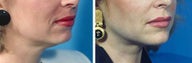 Chin Implant