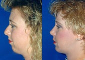 Chin augmentation and Rhinoplasty