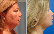 48 year old female who underwent liposuction of neck 