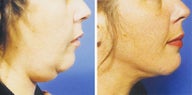 Chin Liposuction