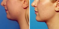 Chin Liposuction
