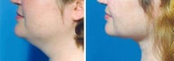 Chin Liposuction