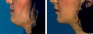 Chin Liposuction
