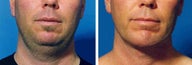 Chin Liposuction