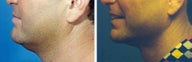 Chin Liposuction