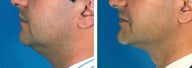 Chin Liposuction