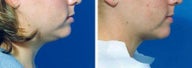 Chin Liposuction